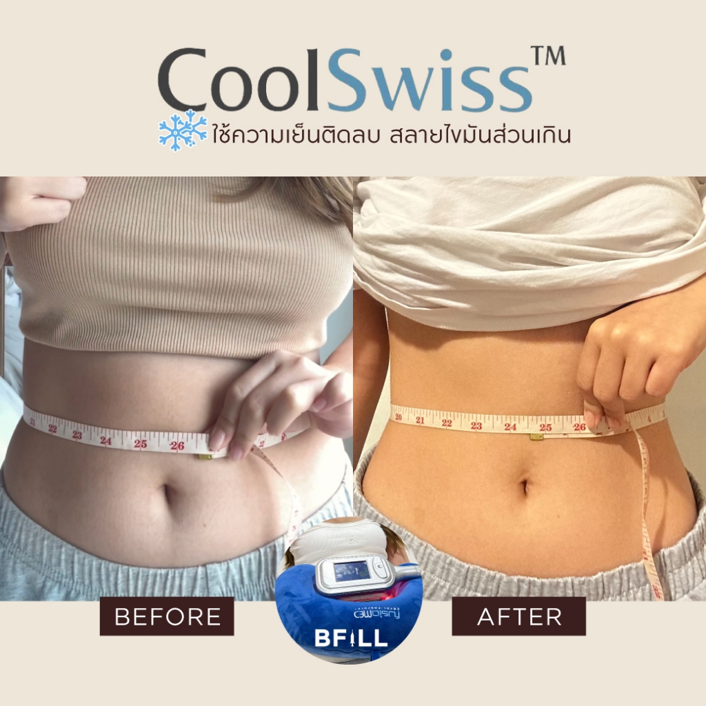 Coolswiss สลายไขมันด้วยความเย็น ติดลบ เฉพาะ สาขาทองหล่อ 1 หนีบ ฟรี 1 หนีบ (ที่ทำพร้อมกันได้เท่านั้น)