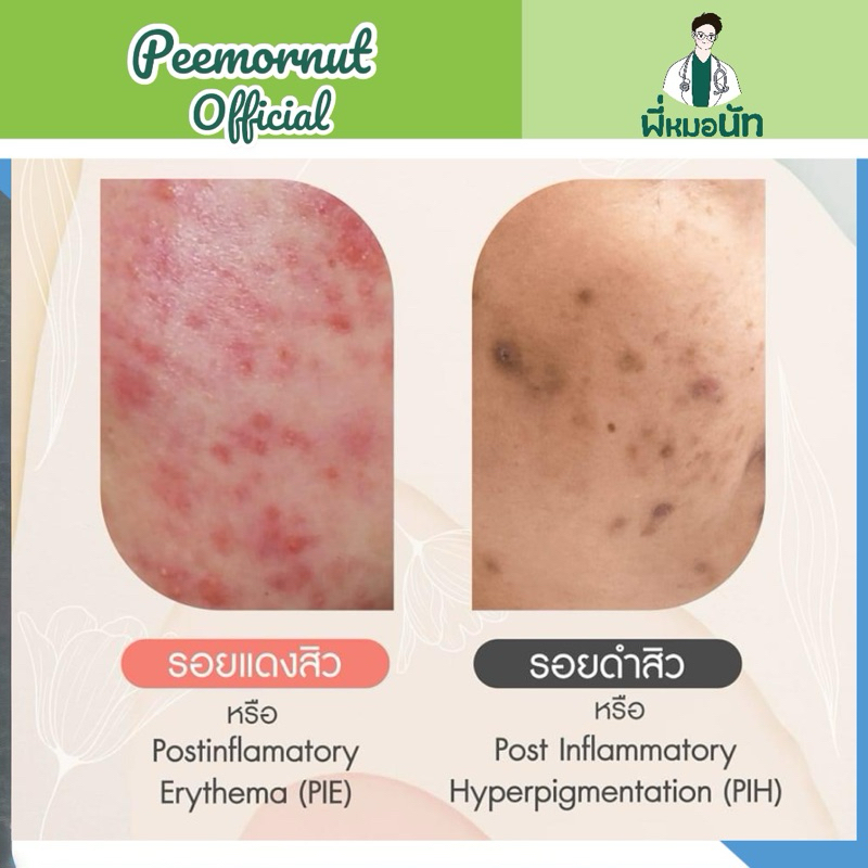 G05 ครีมแต้ม ลดรอยสิว แต้มรอยสิว แผลสิว รอยแดง รอยดำ เจลรักษารอยสิว รอยสิว  สูตรพี่หมอนัท สูตรคลินิก