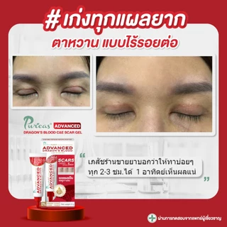 เซ็ตทดลอง จัดการทุกรอยแผล Puricas scar 3g.หรือ Intensive Dark Spot 3g. หรือ Advanced 3g.