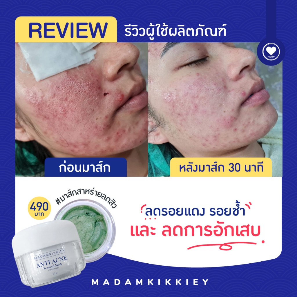 ***ส่งฟรี*** พร้อมส่ง มาส์กสาหร่าย v.พี่กุ้งกดสิว มาดามกิ๊กกี้ ลอตใหม่ล่าสุด