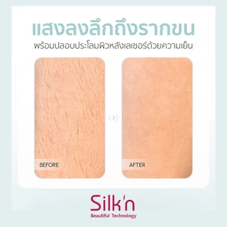 SIIk'n IPL GEN4 GEN3เครื่องกำจัดขนบนใบหน้า & เครื่องกำจัดขนด้วยเลเซอร์บิกินี่ (99,999 Shot)