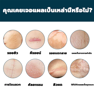 EELHOE ครีมทารอยแผลเป็น50ML รักษารอยแผลเป็น แผลผ่าตัด ทาแผลเป็น ทาแผลเป็นนูน ครีมทาแผลเป็น ครีมลบแผลเป็น