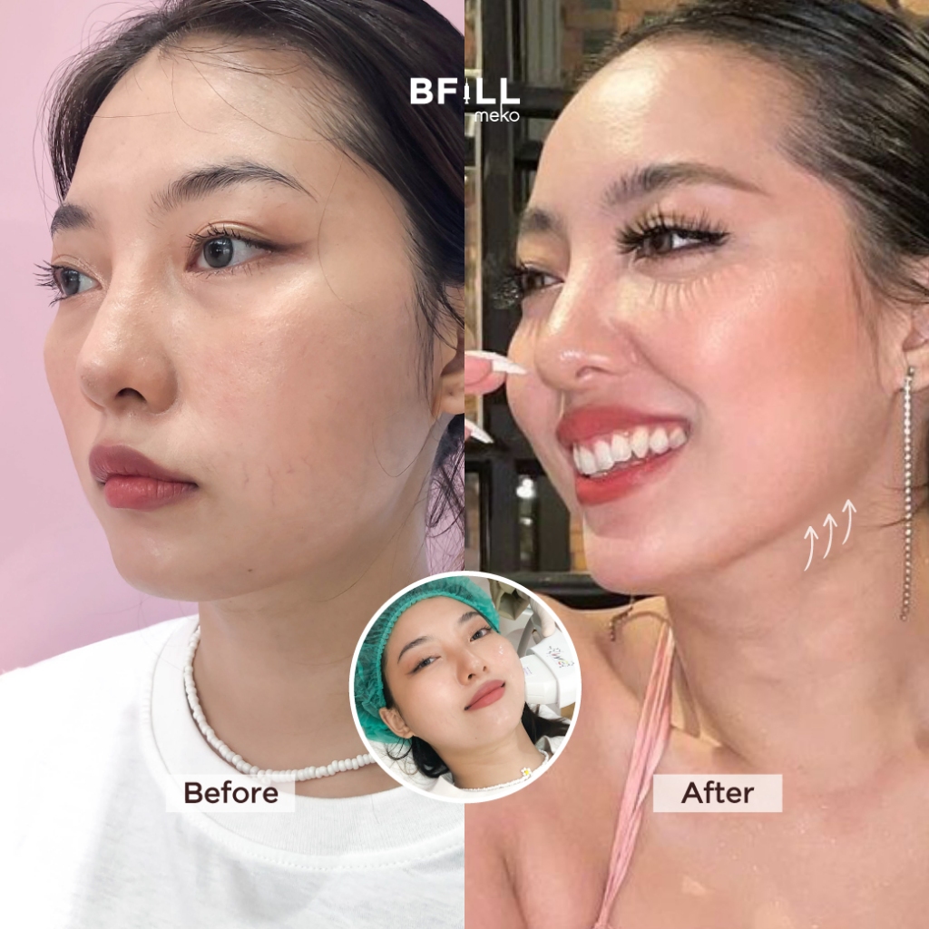 DUO Set Premium Hifu + Thermage Korea By Specialist เซตคู่หู ยกกระชับ พรีเมียมไฮฟู่ + เทอมาจเกาหลี ทำโดยผู้เชี่ยวชาญ