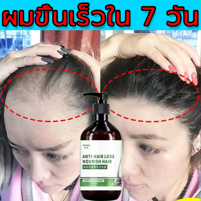 ปรับปรุงสภาพเส้นผม แชมพูแก้ผมร่วง บำรุงรากผม ปรับปรุงคุณภาพเส้นผม บำรุงผม เร่งผมยาว แชมพูเร่งผมยาว ยาสระผมแก้ร่วง