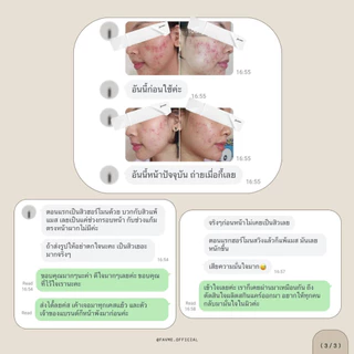 Lovelist เซตลดสิวฟื้นฟูผิว เซรั่ม Herbpy Secret + ครีม Moon Night