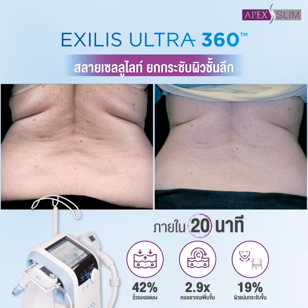 [E-Voucher] APEX โปรแกรม Fit Firm ยกกระชับ ลดไขมันส่วนเกิน พุง ต้นขา หุ่นเฟิร์ม ทดลอง 1 ครั้ง - รูปที่ 4
