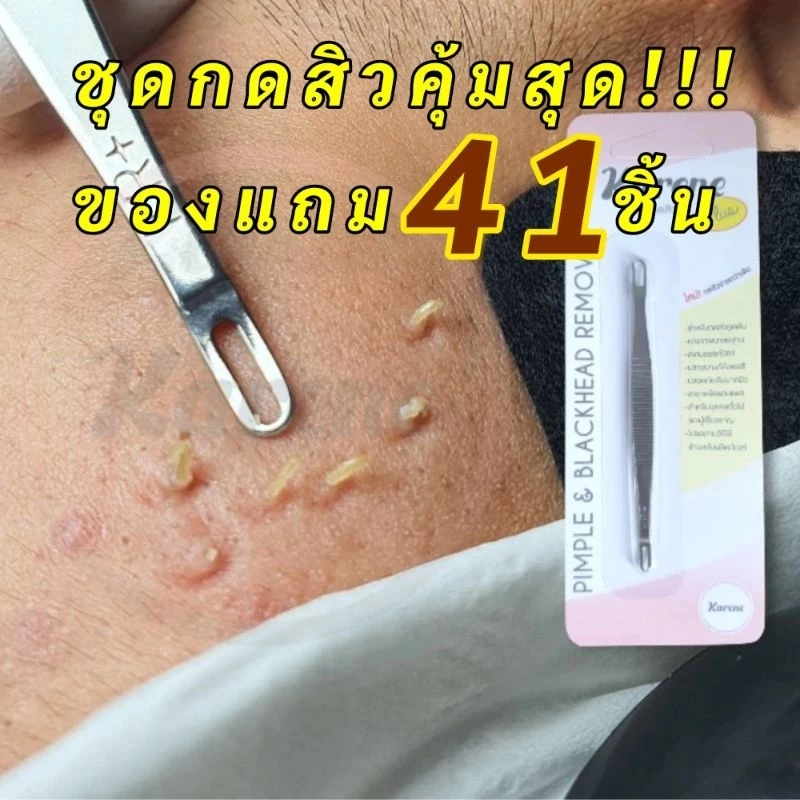 🥳ใหม่!เปลี่ยนแพคเกจเป็นแบบสไลด์!ดีมาก ที่กดสิว1ชิ้น ฟรีที่เปิด20ชิ้น+แอล20+หลอดเก็บ ที่กดสิว KR+ รุ่นรพ.และคลินิกใช้