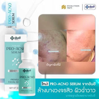 Yanhee Pro Acno Serum |โปรเอ็กโน่ 1 ขวด| ยันฮีโปรเอกโน่ เซรั่ม สิว ผลิตภัณฑ์ลดปัญหา สิว รอยดำ รอยแดง จากยันฮี