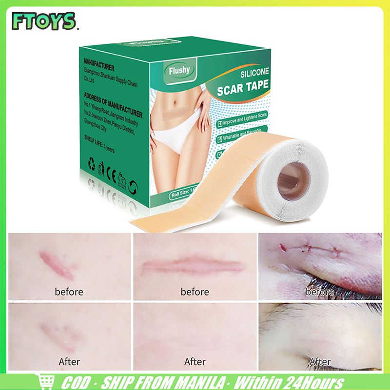 พร้อมส่ง แผ่นซิลิโคนแปะแผลเป็น เผยผิวเนียนสวย 4cm*150cm แผ่นปิดแผล รักษารอยแผลเป็น