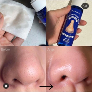 🌼โทนเนอร์กำจัดสิวเสี้ยนสิวหัวดำ One-day's you P.Z SSOC SSOC No More Blackhead 100 ml