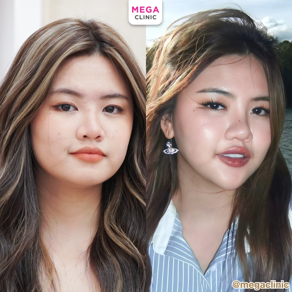 [E-voucher] โปรหน้าเรียวผิวใสไซส์ S โบท็อก+งานผิว ย้ำฟรีอีก 1 ครั้ง (ปกติ 7,300.-) MEGA CLINIC เมกะค