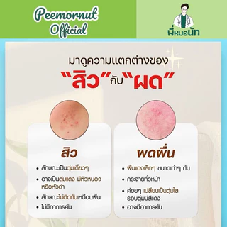 E02 ครีมทารักษาสิวผด สิวยีสต์ สิวผดร้อน ผิวติดสาร สูตรคลินิก สูตรพี่หมอนัท ป้องกันสิวผด รักษาสิวยีส คนเป็นสิว ผิวแพ้ง่าย