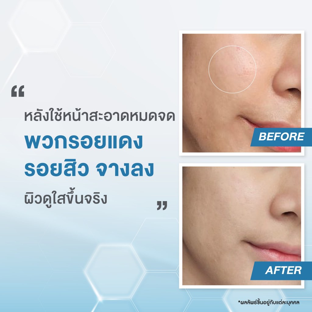 Nu Formula Pore Deep Clarifying Foam 150g นูฟอร์มูล่า พอร์ ดีพ แคลริฟายอิ้ง โฟม โฟมล้างหน้า 150g