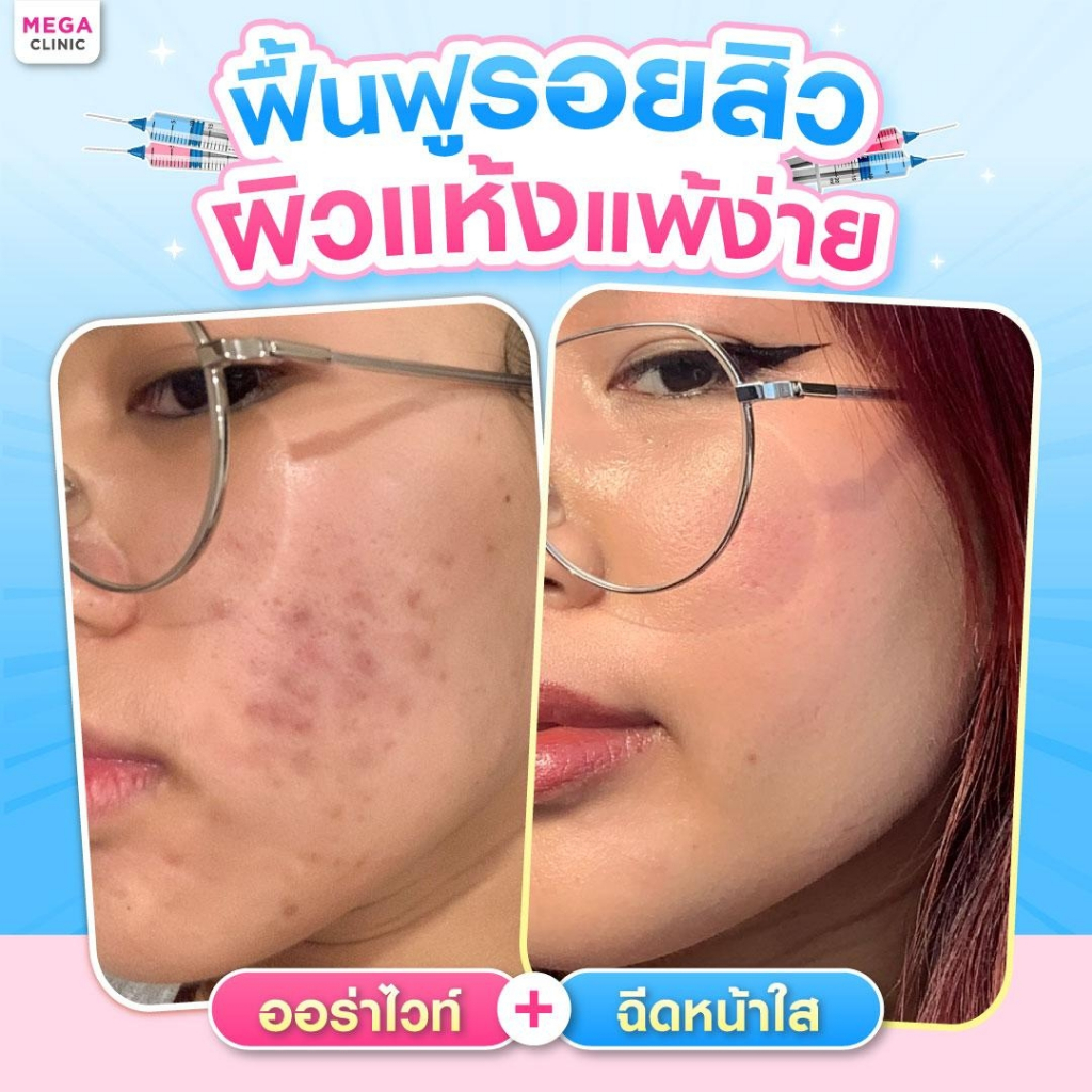 [E-voucher] ฉีดออร่าไวท์/ฉีดหน้าใส ลดรอยสิว เติมความชุ่มชื้น (แลกซื้อ 99 บาท) จากปกติ 1,900 บาท

<p>“><center></p>
<h4></h4>
<p><p><font color=