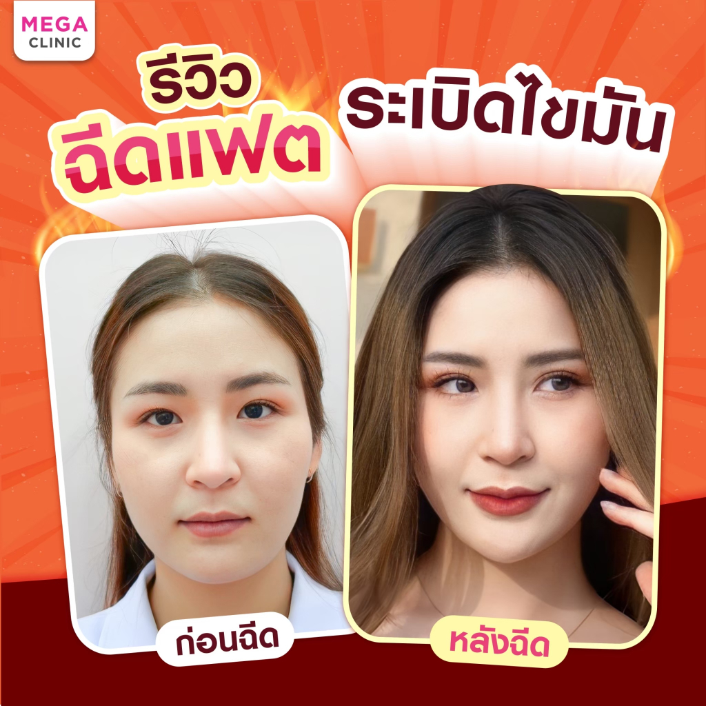 [E-voucher] ฉีดแฟตเข้มข้น ไม่ผสมน้ำเกลือ (แลกซื้อ 99 บาท) จากปกติ 2,900 บาท