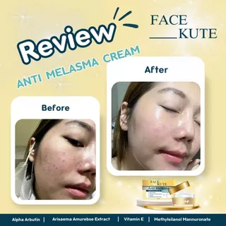 ครีมทาฝ้า ลดฝ้า กระ จุดด่างดำ หน้าขาว 15g Anti Melasma Cream // Alpha Arbutin 2.0%