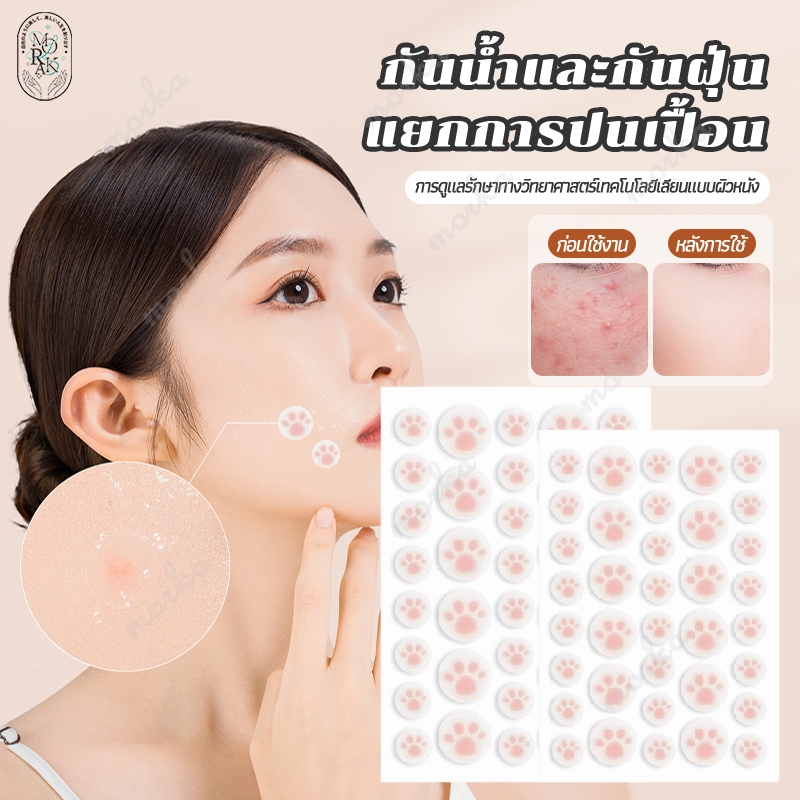 แผ่นดูดสิว แผ่นสติกเกอร์แปะสิว แผ่นแปะสิว แผ่นสิว สติกเกอร์แปะสิว สําหรับติดตกแต่งสิว น่ารัก