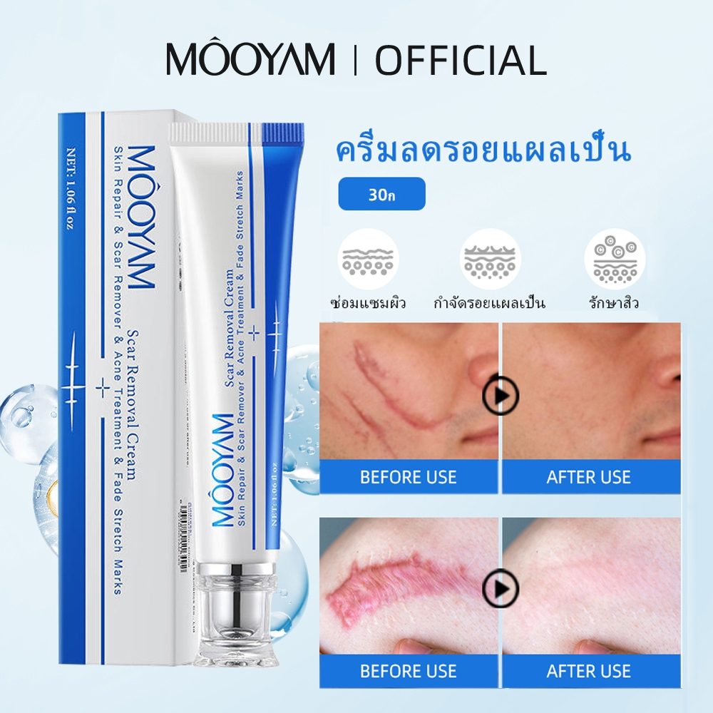 MOOYAM ครีมลบรอยแผลเป็น ครีมซ่อมแซมรอยแผลเป็นบนใบหน้าและร่างกาย เจลซ่อมแซมรอยแผลเป็นทั้งรอยแผลเป็นเก่าและใหม่ 30g