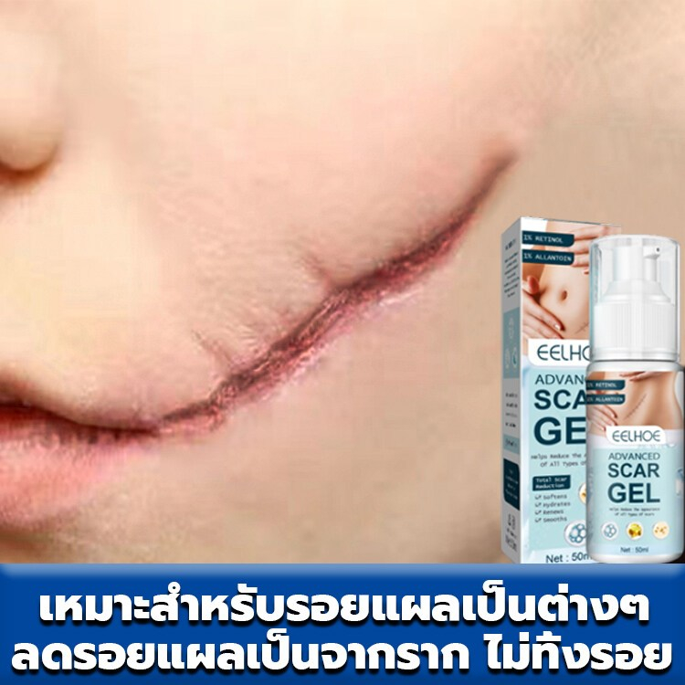【เหมาะกับแผลเป็นทุกชนิด】 EELHOE 50g ยาทาแผลเป็น ลดรอยสิว รอยดำ ลดแผลไฟไหม้ แผลน้ำร้อนลวก ครีมทาแผลเป็น