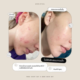 Lovelist เซตลดสิวฟื้นฟูผิว เซรั่ม Herbpy Secret + ครีม Moon Night