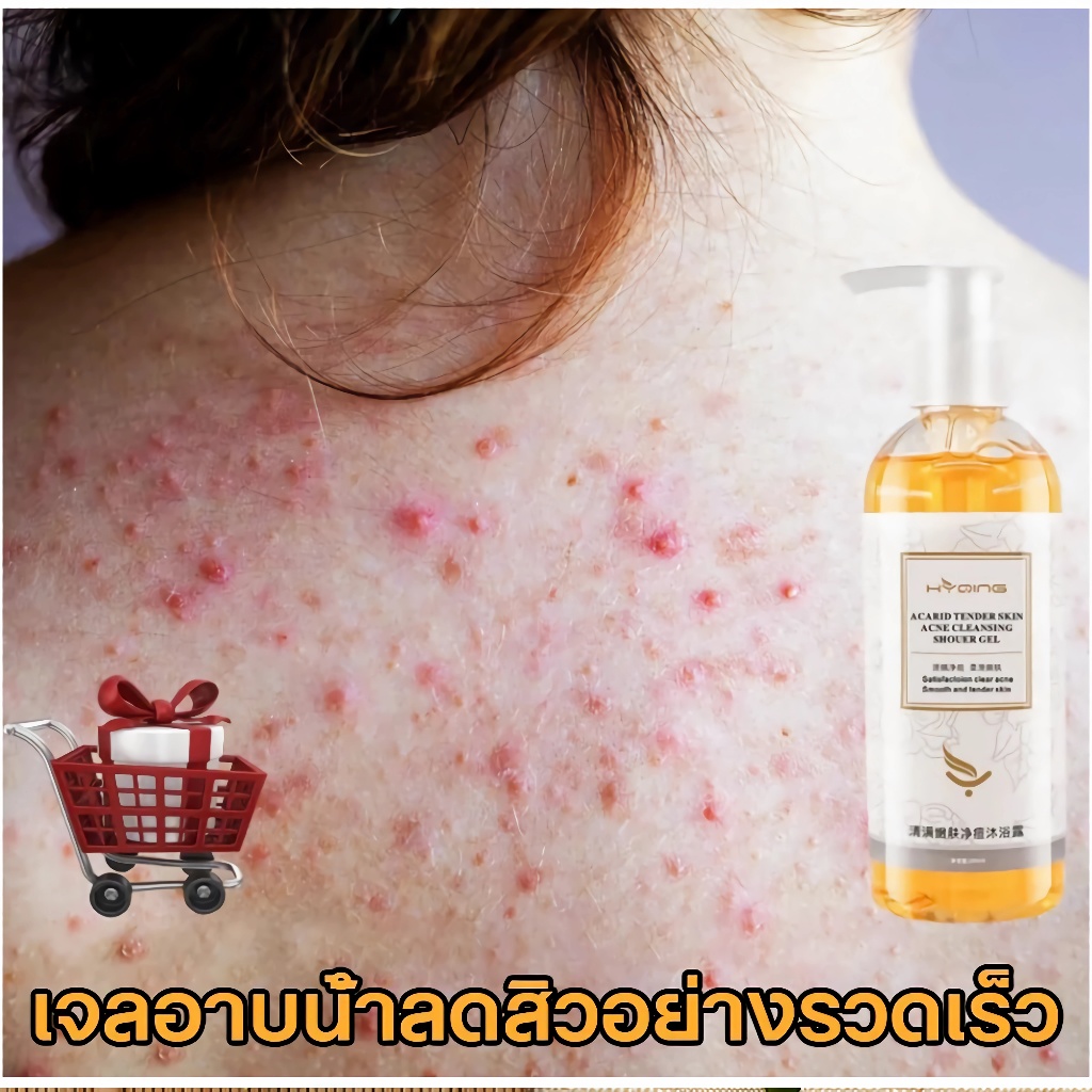 (ของแท้) ครีมอาบน้ำกำจัดไร 260ml ครีมอาบน้ํา เจลอาบน้ำลดสิว กำจัดไรลดสิว ผลัดเซล์และขจัดสิ่งสกปรก ซื้อ 2 แถม 1