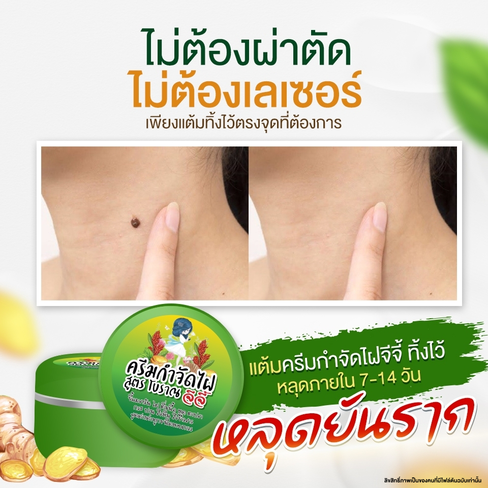 ครีมไฝจีจี้ ติ่งเนื้อ ตาปลา ขี้แมลงวัน หูด ไฝ แก้ปัญหา สิวหิน กระ ไฝ ตาปลา หูด จี้หูด แต้มไฝ