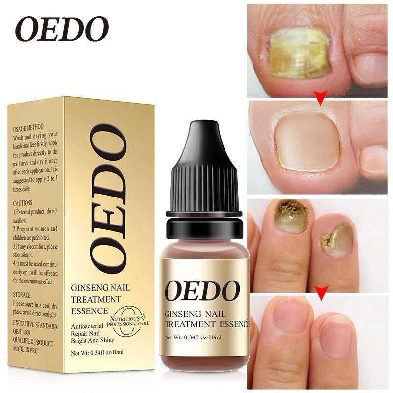 OEDO FDA รักษาเชื้อราเล็บ