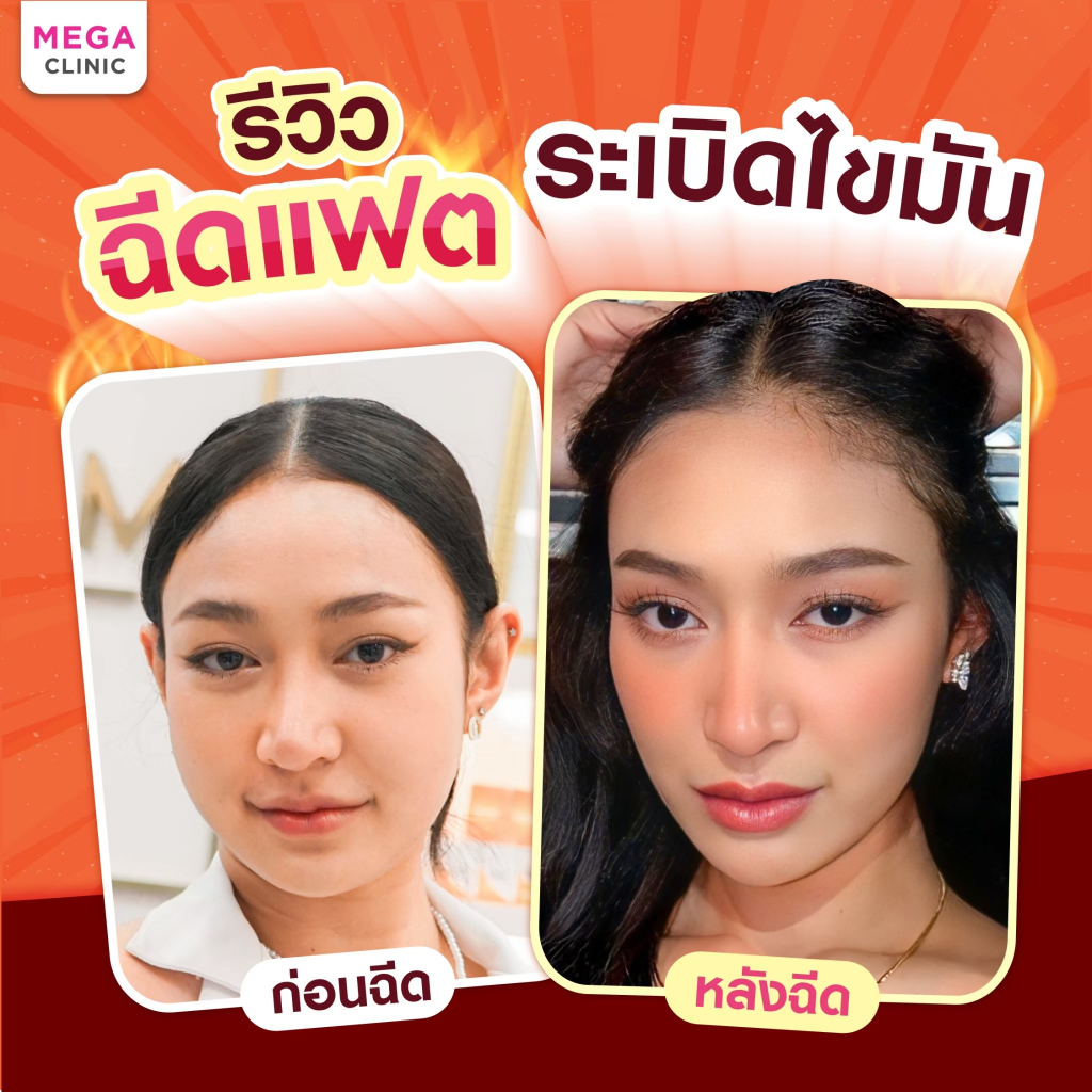 [E-voucher] ฉีดแฟตเข้มข้น ไม่ผสมน้ำเกลือ (แลกซื้อ 99 บาท) จากปกติ 2,900 บาท
