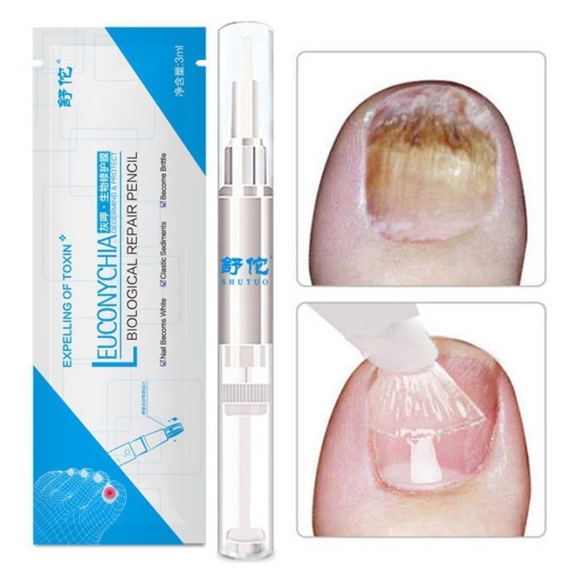 Nail Serum บํารุงเล็บ เซรั่มบำรุงเล็บ แก้ปัญหาเล็บ ปากกาเล็บเท้า ซ่อมเล็บที่ชำรุด มีประสิทธิภาพ