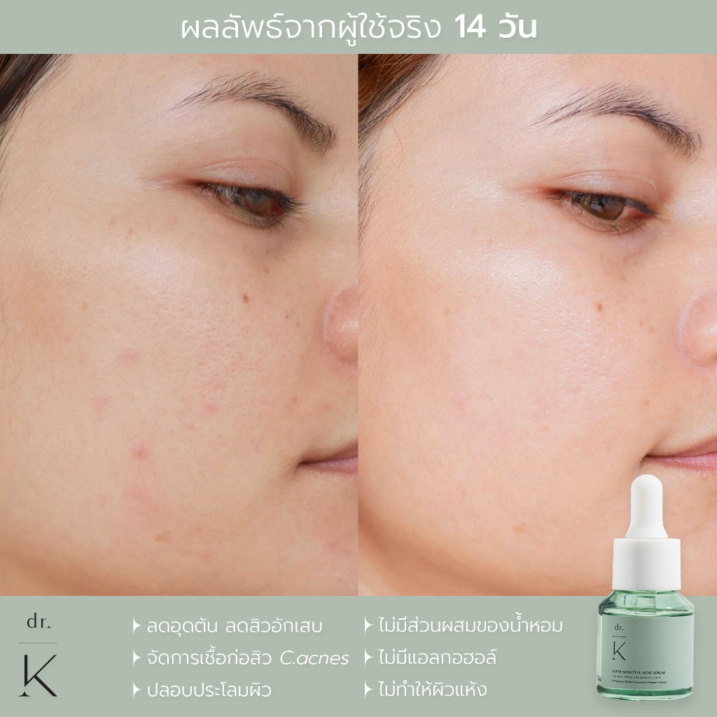 ลอตใหม่ (เซรั่มสิว หมอเก่ง) Dr.K super sensitive acne serum เซรั่มลดสิว สูตรอ่อนโยน สำหรับผิวแพ้ง่าย ราคา ถูกที่สุด ดีลบีเคเค แกลเลอรีภาพที่ 5