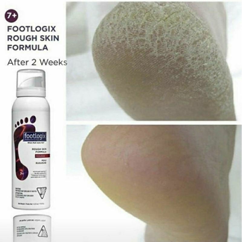 Footlogix โฟมมูส Mousse Rough skin #7+ แก้ปัญหาส้นเท้าแห้ง แข็ง ของแท้นำเข้าจาก CANADA พร้อมส่ง