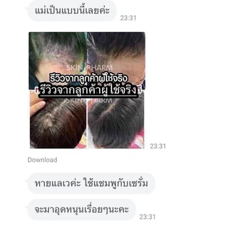 (เจ้าของ)เซ็ทครีม แชมพูและเซรั่ม รังแค หนังศีรษะลอก อักเสบ เซ็บเดิร์ม ต่อมไขมันอักเสบ สิวที่หัว