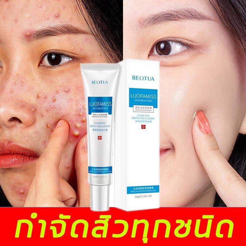 ครีมลดสิว ของแท้100% พร้อมส่งจากไทย 30g สำหรับผิวที่เป็น สิว สิวผด ลดเลือนรอยสิว ครีมกำจัดสิว