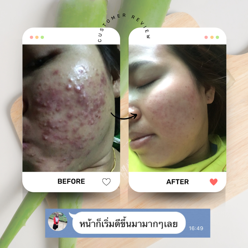 KAPOR เจลว่านหางจระเข้ สูตรลดสิว ลดรอย ฟื้นฟูผิวติดสาร