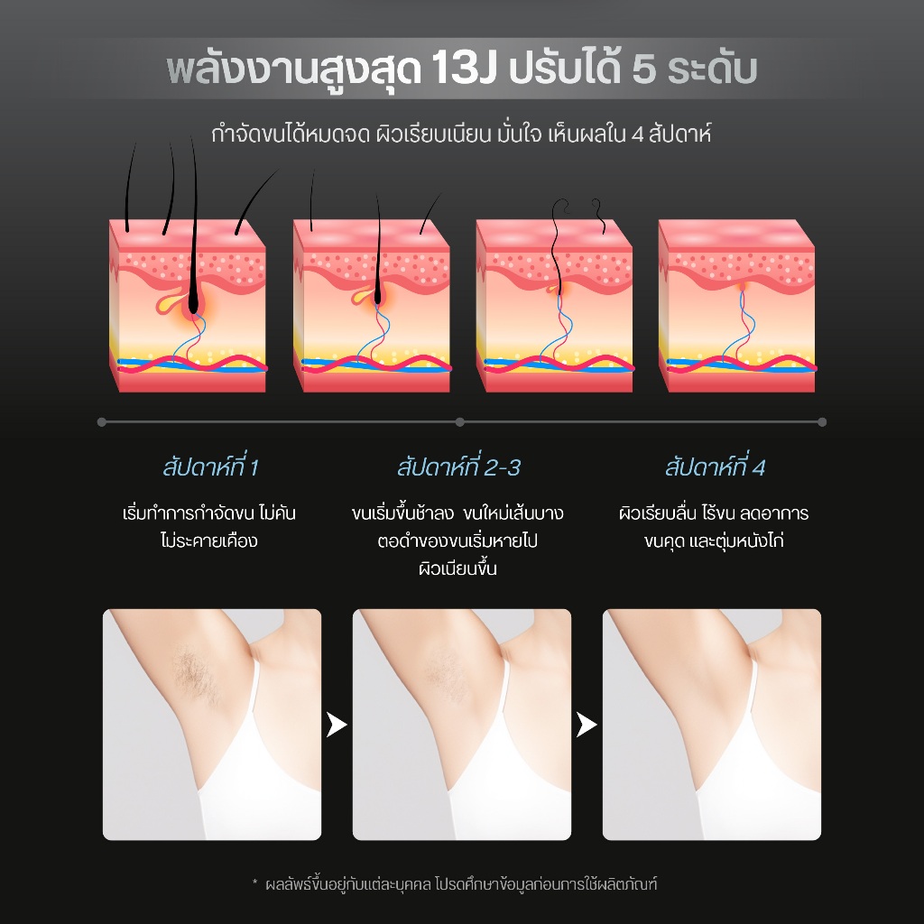 New! CBG Devices เครื่องเลเซอร์กำจัดขนถาวร IPL รุ่น CLOUD กำจัดขนทั่วร่างกาย พร้อมโหมดหน้าใส ลดสิว ผิวสวย(IPC)