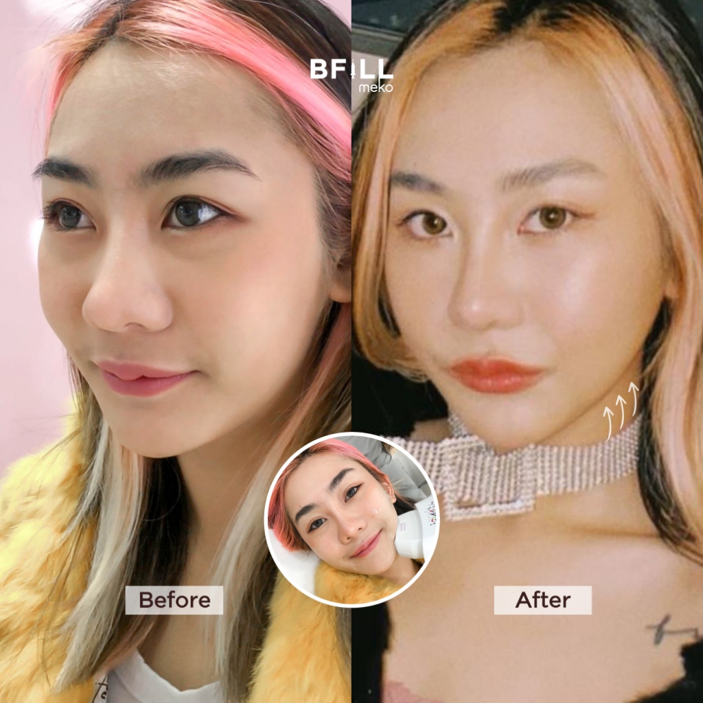 DUO Set Premium Hifu + Thermage Korea By Specialist เซตคู่หู ยกกระชับ พรีเมียมไฮฟู่ + เทอมาจเกาหลี ทำโดยผู้เชี่ยวชาญ