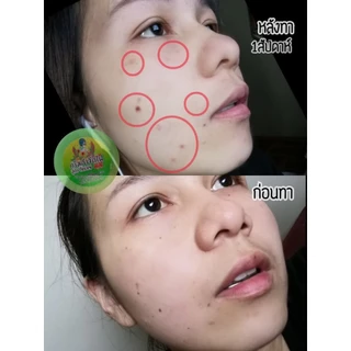 ครีมไฝจีจี้ ขี้แมลงวัน ติ่งเนื้อ หูด ตาปลา แก้ปัญหา สิวหิน หูด ติ่งเนื้อ ตาปลา ครีมแต้มไฝจีจี้ไฝ หูด จี้ไฝ แต้มไฝ