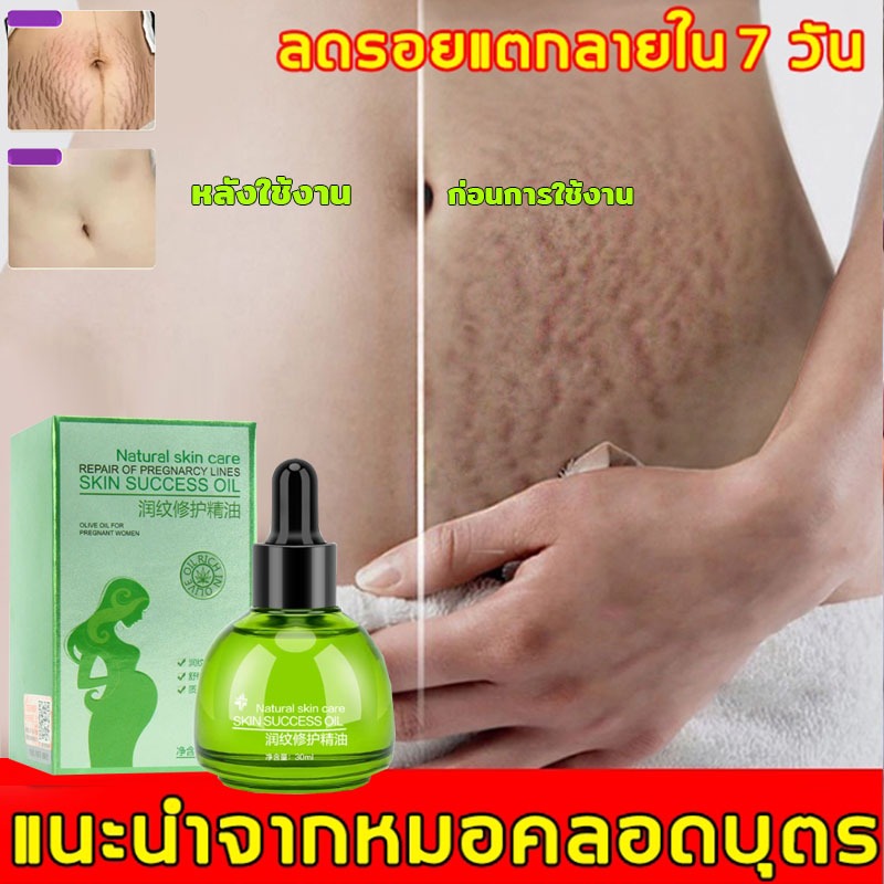 "ครีมซ่อมแซมรอยเลือดและรอยคล้ำหลังคลอดช่วยลดรอยแห่งการตั้งครรภ์ ป้องกันรอยคล้ำของหญิงตั้งครรภ์ รอยดำบนท้องและน้ำมันบำรุง