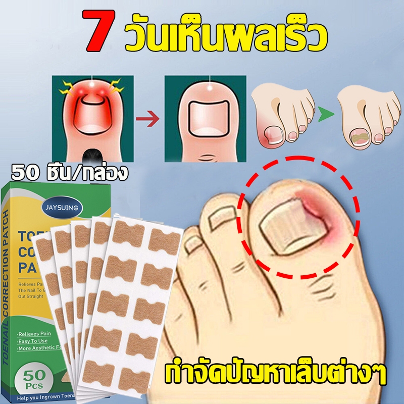 พร้อมส่ง แผ่นแปะเล็บขบ 1กล่อง/50แผ่น ป้องกันเล็บขบนิ้วเท้า แผ่นแปะดูแลเล็บเท้า สติ๊กเกอร์เล็บขบ แผ่นติดเล็บขบ
