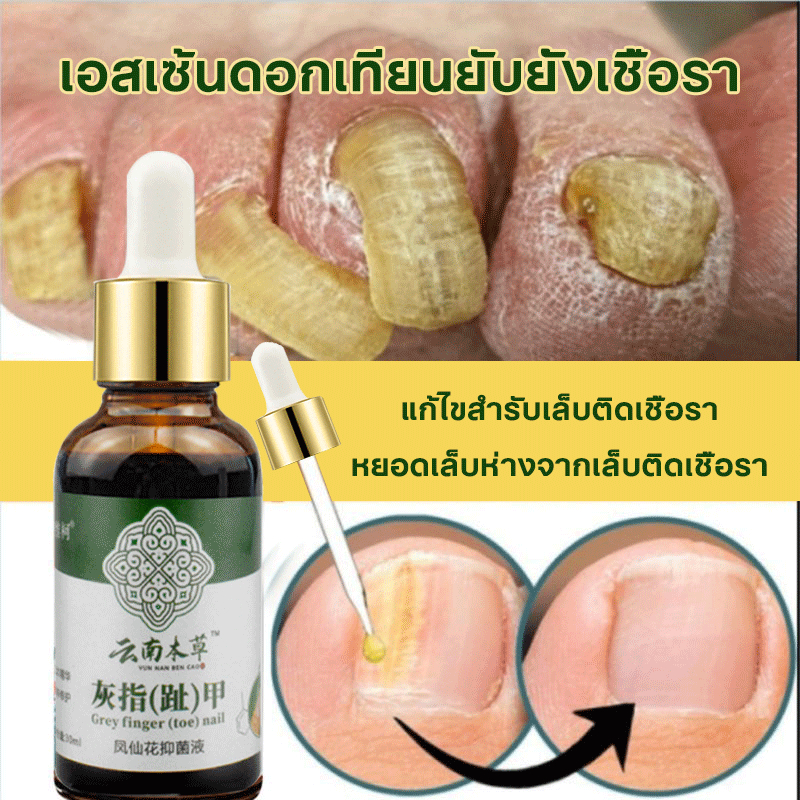 เอสเซ้นดูแลเท้า ดูแลเล็บ ซ่อมแซมเล็บแตก 30ml รักษาเชื้อราที่เล็บ ป้องกันเชื้อรา เล็บเปราะ เล็บหนา ยาทาเล็บ ซื้อ 2 ให้ 1