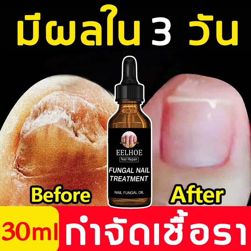 บำรุงเล็บ กันเชื้อราเล็บ เซรั่มบำรุงเล็บ เชื้อราเล็บมือ แก้เชื้อราที่เล็บ บำรุงเล็บ ลากับเล็บเสีย ไม่ทำร้ายเล็บดี ห่างกั