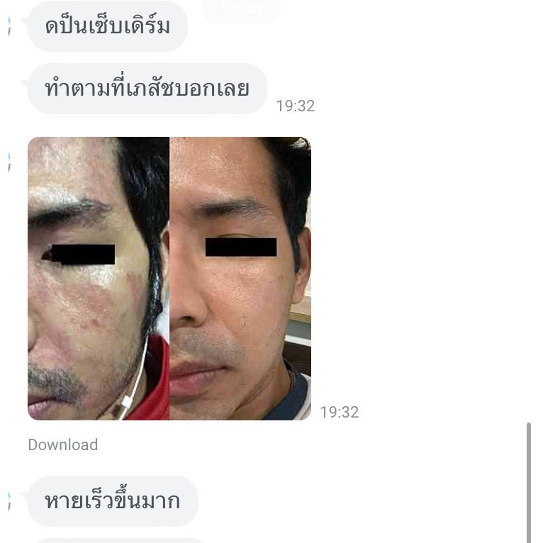 (ของแท้!!) เซรั่ม Anti-sebderm D-Derma เซ็บเดิร์ม ผิวแห้ง ลอก คัน ผิวหนังอักเสบ แพ้ง่าย ผดผื่น รูปที่ 8