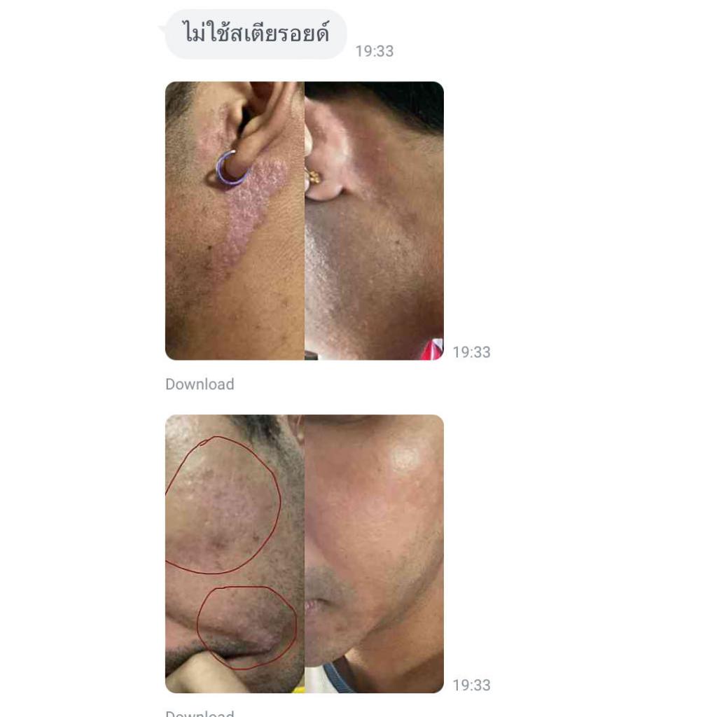 (ของแท้!!) เซรั่ม Anti-sebderm D-Derma เซ็บเดิร์ม ผิวแห้ง ลอก คัน ผิวหนังอักเสบ แพ้ง่าย ผดผื่น รูปที่ 2