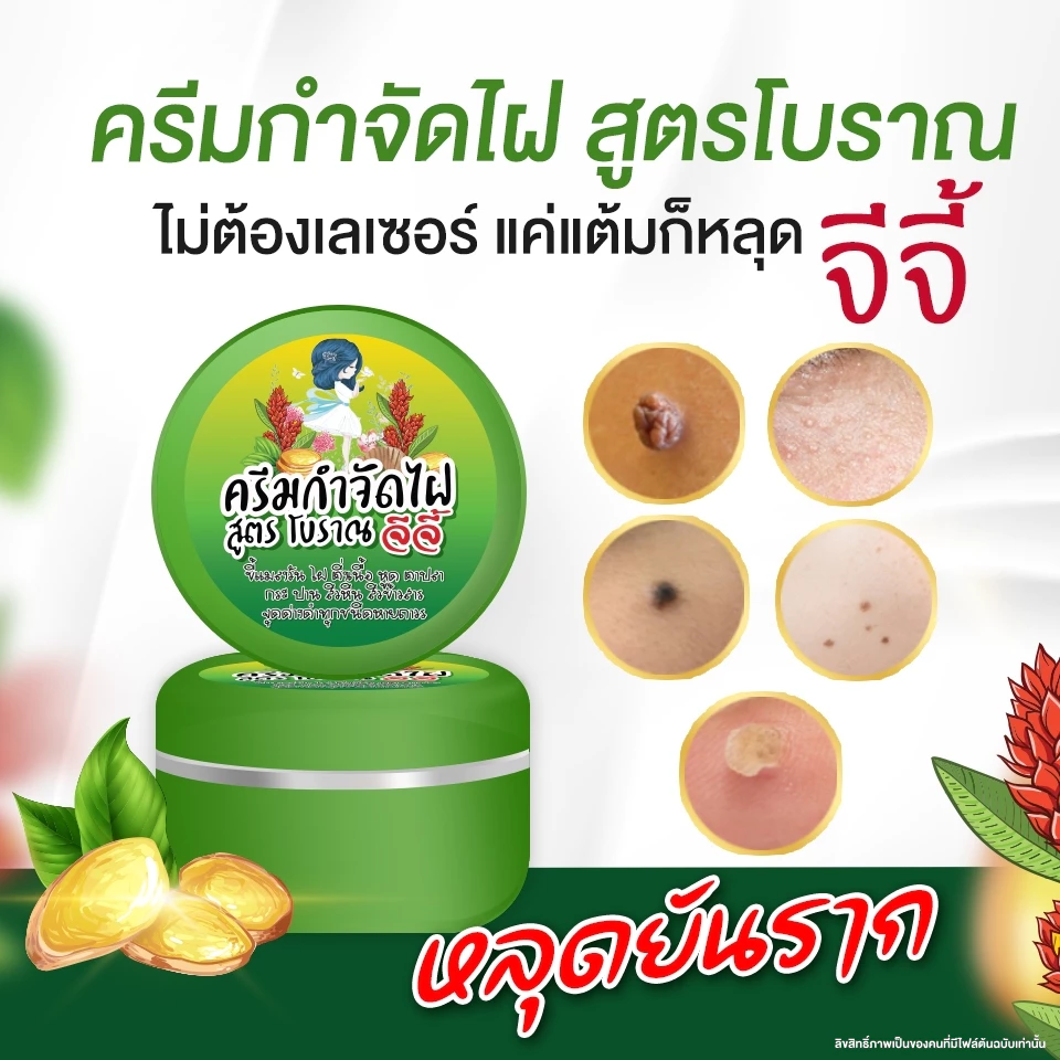 ครีมไฝจีจี้ ขี้แมลงวัน ติ่งเนื้อ หูด ตาปลา แก้ปัญหา กระ สิวหิน ครีมแต้มติ่งเนื้อจีจี้ไฝ หูด จี้ไฝ แต้มไฝ