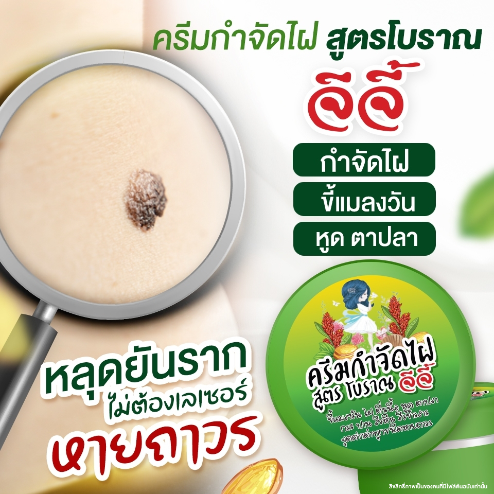 ครีมไฝจีจี้ ขี้แมลงวัน ติ่งเนื้อ หูด ตาปลา แก้ปัญหา กระ สิวหิน ไฝ หูด จี้หูด แต้มไฝ
