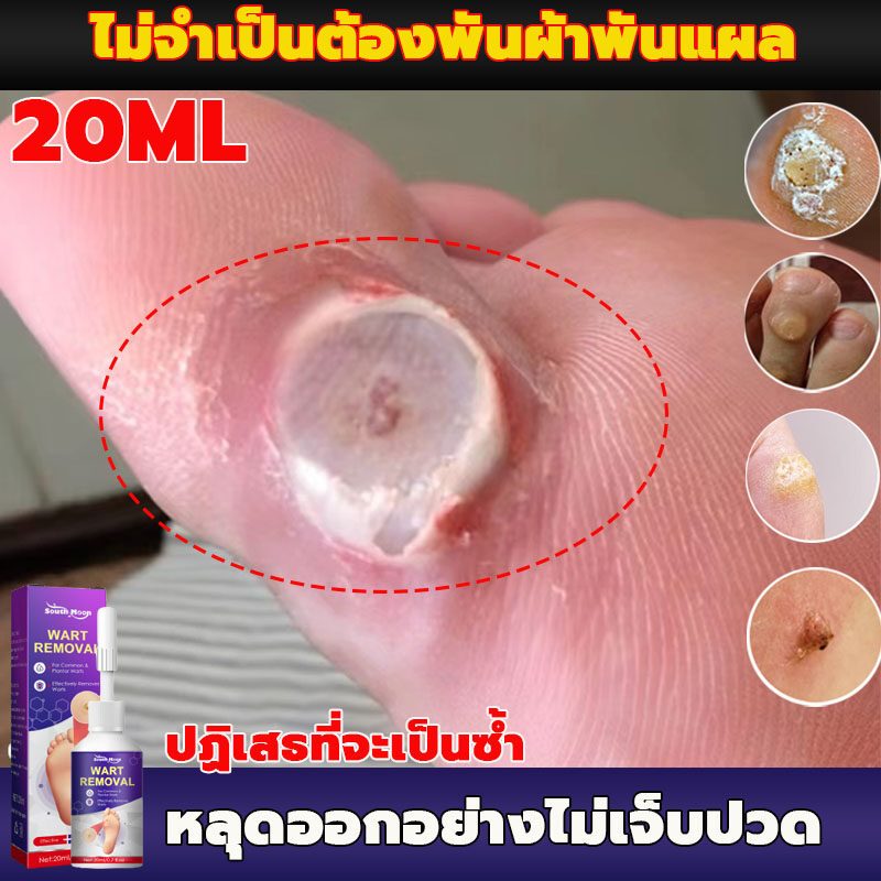 （ไม่เจ็บปวดหลุดออก/COD）South Moon 20ml ตาปลา เห็นผลดีเมื่อใช้ต่อเนื่อง หายจริง ผิวเรียบเนียน แผ่นแปะตาปลา พลาสเตอร์ติดตา