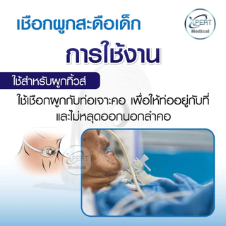 เชือกผูกสะดือ ผูกทิ้วส์ หลอดทดลอง เชือกทางการแพทย์ ผู้ป่วยเจาะคอ เชือกผูกสายฟอกไต Tube wires rope