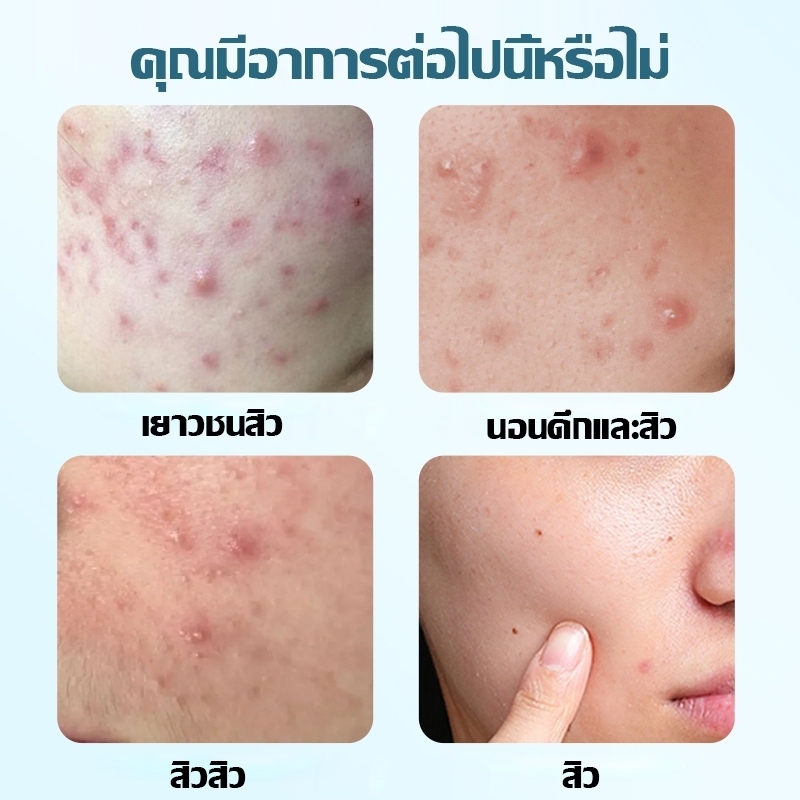 แผ่นแปะสิว แผ่นสติกเกอร์แปะสิว แผ่นแปะดูดสิว แผ่นสิว สติกเกอร์แปะสิว แผ่นดูดสิว สําหรับติดตกแต่งสิว รูปดาวน่ารัก 3 สี - รูปที่ 5