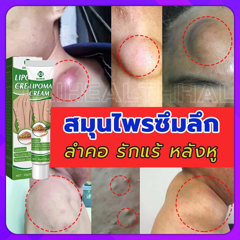 [ความนิยม] OUHOE ออกแบบ36ชนิดของไขมันใต้ผิวหนังกำจัดมวลก้อนไปยังถุงน้ำ Lymph Care Ointment สมุนไพรกำจัด ก้อนเนื้อใต้ผิวห