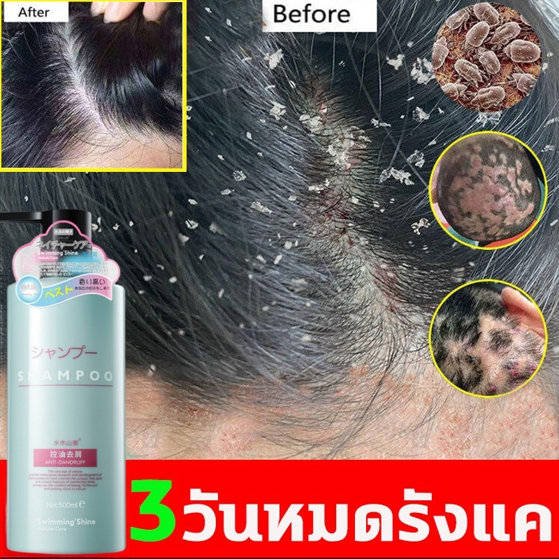 แชมพูแก้คัน ยาสระผม ยาสระผมขจัดรังแค 500ml ยาสระผมผมร่วง แชมพูขจัดรังแค ควบคุมความมัน ขจัดรังแค ลดผมร่วง บํารุงรากผม